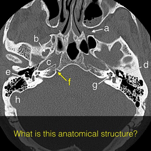 File:Anatomy Quiz (Skull base) (Radiopaedia 41833-44822 Axial 12).jpeg