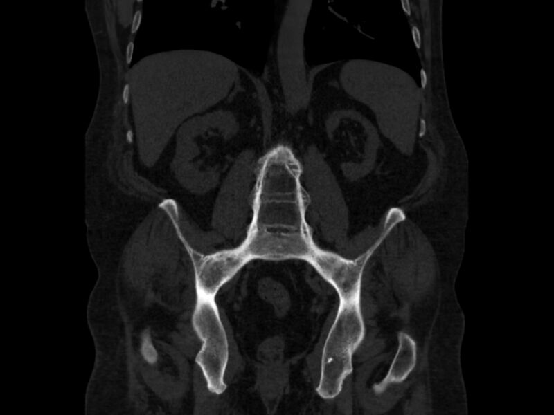 File:Ankylosing spondylitis (Radiopaedia 44609-48357 Coronal bone window 51).jpg