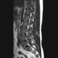 Ankylosing spondylitis with zygapophyseal arthritis (Radiopaedia 38433-40516 Sagittal T2 8).jpg