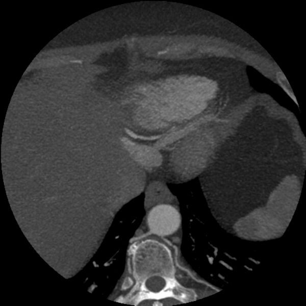 File:Anomalous origin of left circumflex artery from right coronary sinus (Radiopaedia 72563-83117 A 6).jpg