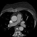 Anomalous origin of left circumflex artery from right coronary sinus (Radiopaedia 72563-83117 B 14).jpg