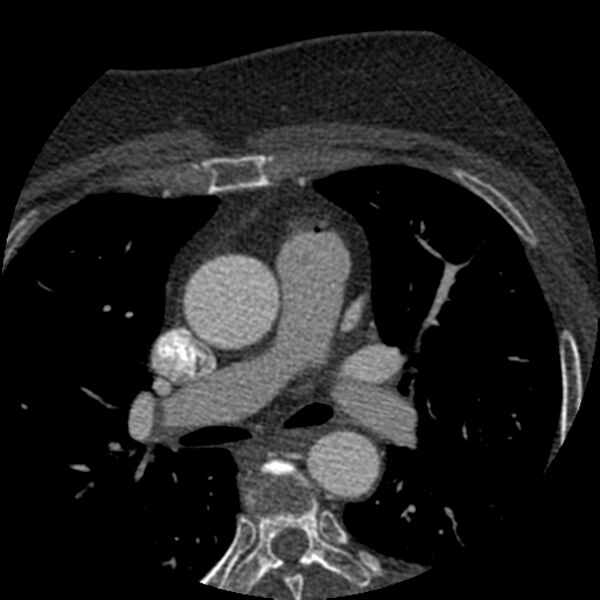 File:Anomalous origin of left circumflex artery from right coronary sinus (Radiopaedia 72563-83117 B 14).jpg