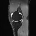 Anterior cruciate ligament full thickness tear (Radiopaedia 66268-75467 Sagittal PD fat sat 8).jpg