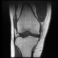 Anterior cruciate ligament tear with posteromedial corner injury, bucket-handle meniscal tear and chondral delamination (Radiopaedia 75501-86744 Coronal T1 10).jpg