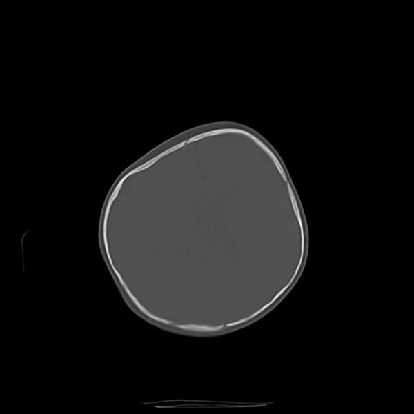 File:Anterior plagiocephaly (Radiopaedia 71836-82273 Axial bone window 13).jpg