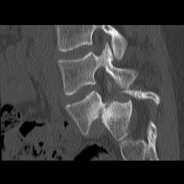 File:Anterolisthesis (Radiopaedia 22226-22263 Sagittal bone window 7).jpg