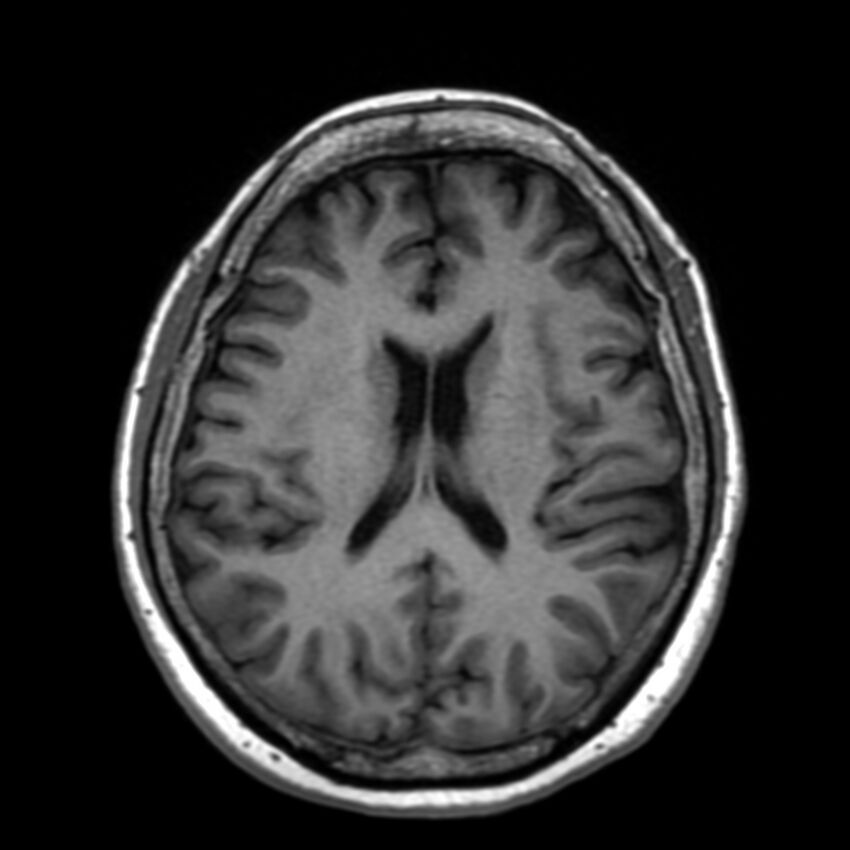 Anti-MOG encephalomyelitis (Radiopaedia 73831-84646 Axial T1 31).jpg