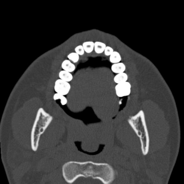 File:Antrochoanal polyp (Radiopaedia 21894-21868 Axial bone window 1).jpg
