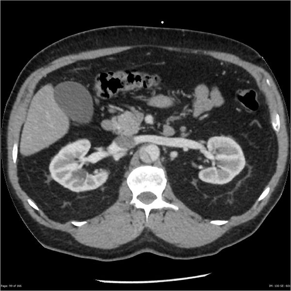 File:Aortic dissection- Stanford A (Radiopaedia 37759-39664 A 90).jpg