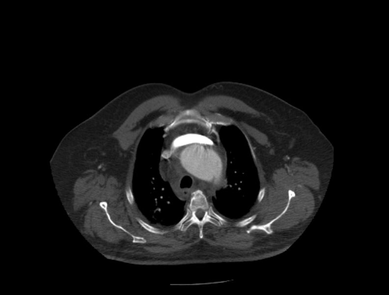 File:Aortic dissection (Radiopaedia 28802-29105 A 4).jpg