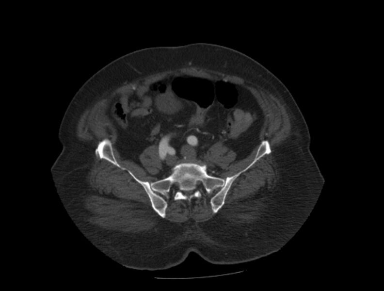 File:Aortic dissection (Radiopaedia 28802-29105 A 83).jpg