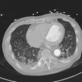 Aortic dissection - DeBakey type II (Radiopaedia 64302-73082 Axial lung window 44).png