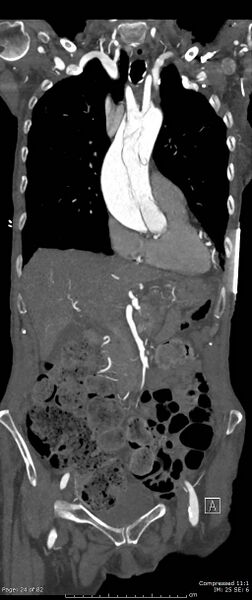 File:Aortic dissection with extension into aortic arch branches (Radiopaedia 64402-73204 A 24).jpg