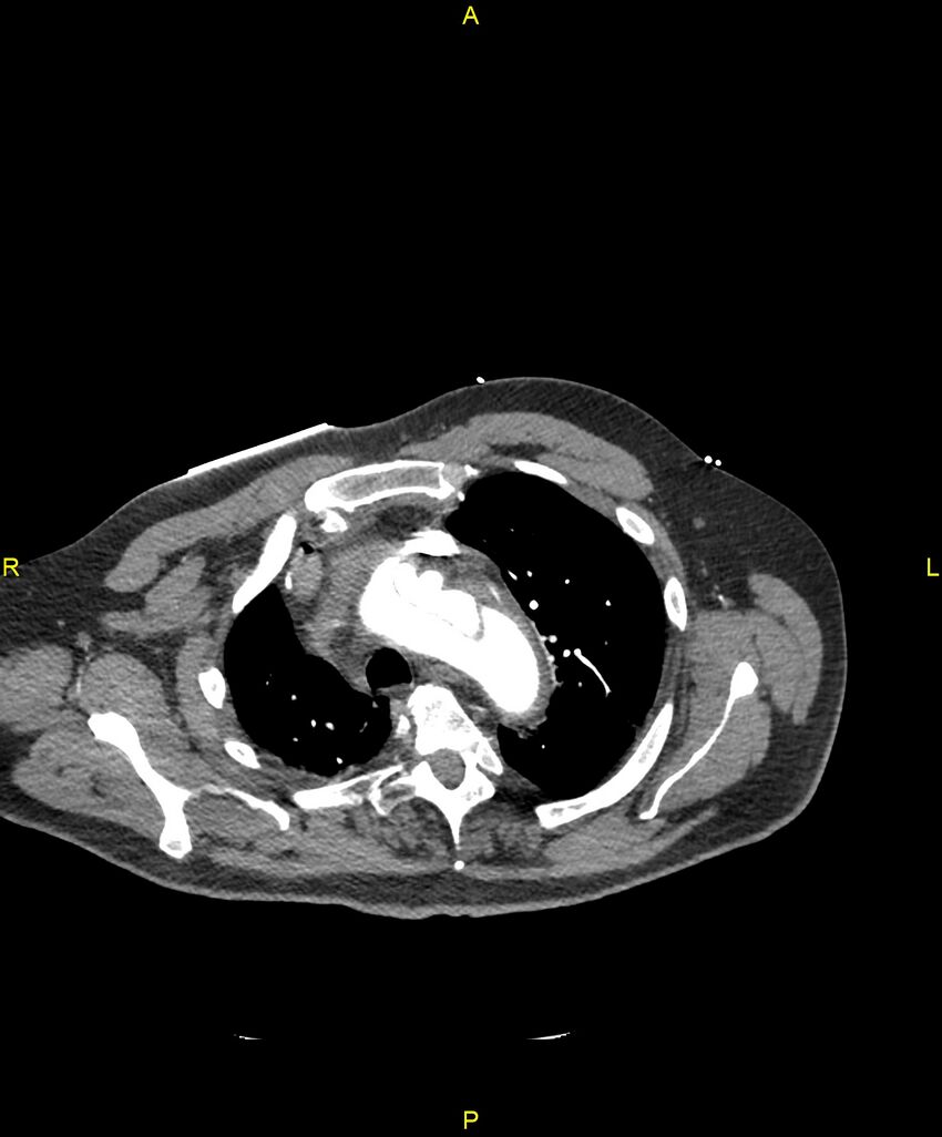 Aortic rupture (Radiopaedia 88822-105594 B 56).jpg