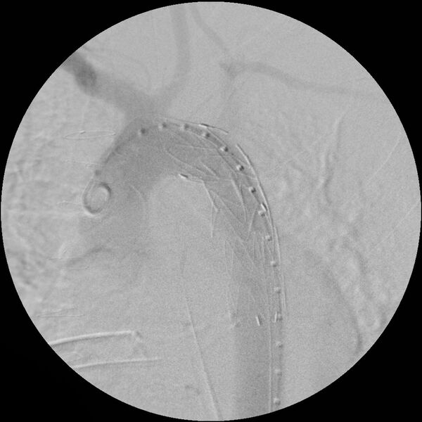File:Aortic transection and subclavian steal (Radiopaedia 8711-9517 Stent 8).jpg