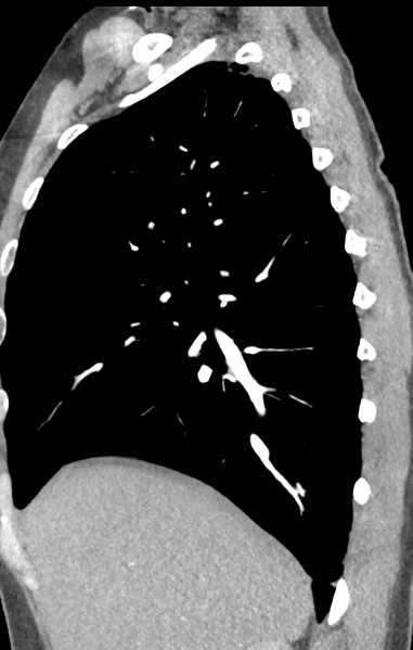 File:Aortic valve non-coronary cusp thrombus (Radiopaedia 55661-62189 C+ arterial phase 50).png