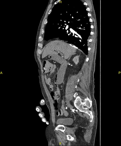 File:Aortoenteric fistula (Radiopaedia 84308-99603 C 131).jpg