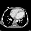 Aortopulmonary window, interrupted aortic arch and large PDA giving the descending aorta (Radiopaedia 35573-37074 B 56).jpg
