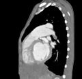 Aortopulmonary window, interrupted aortic arch and large PDA giving the descending aorta (Radiopaedia 35573-37074 C 31).jpg