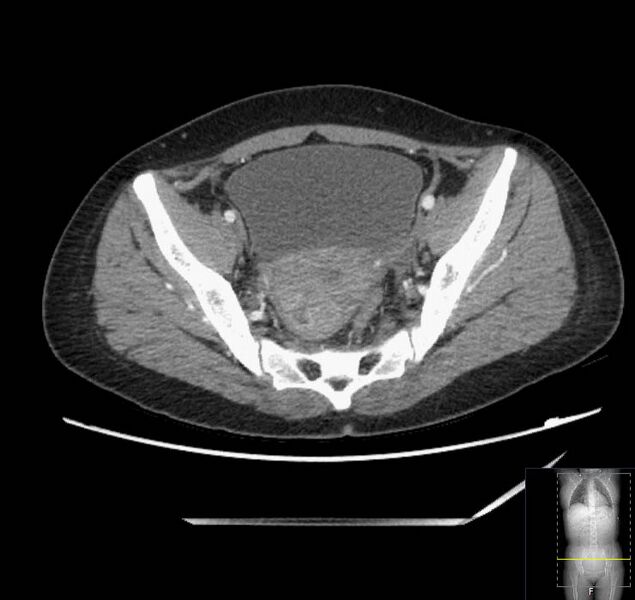 File:Appendicitis (CT angiogram) (Radiopaedia 154713-127660 Axial 24).jpg