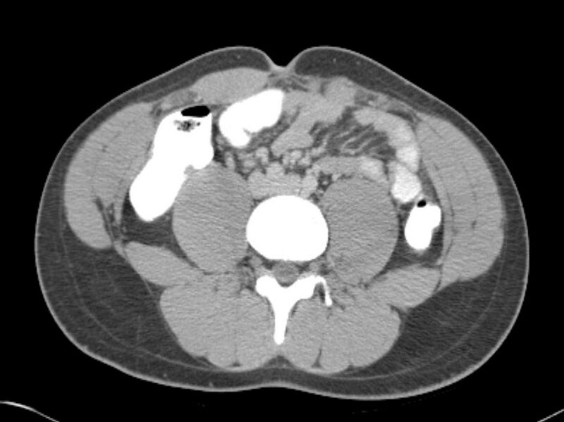 File:Appendicitis and incidental foregut duplication cyst (Radiopaedia 52962-58916 A 48).jpg