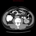 Appendicitis and renal cell carcinoma (Radiopaedia 17063-16760 A 31).jpg