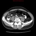 Appendicitis and renal cell carcinoma (Radiopaedia 17063-16760 A 39).jpg
