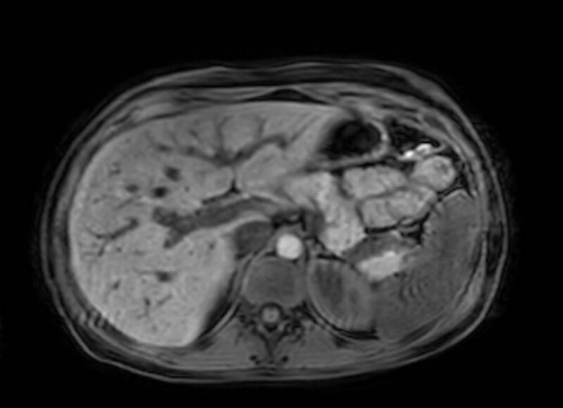 File:Appendicitis in gravida (MRI) (Radiopaedia 89433-106395 Axial DIXON 27).jpg