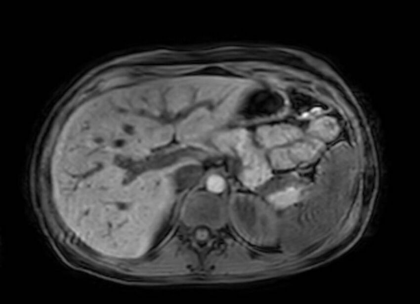 Appendicitis in gravida (MRI) (Radiopaedia 89433-106395 Axial DIXON 27).jpg