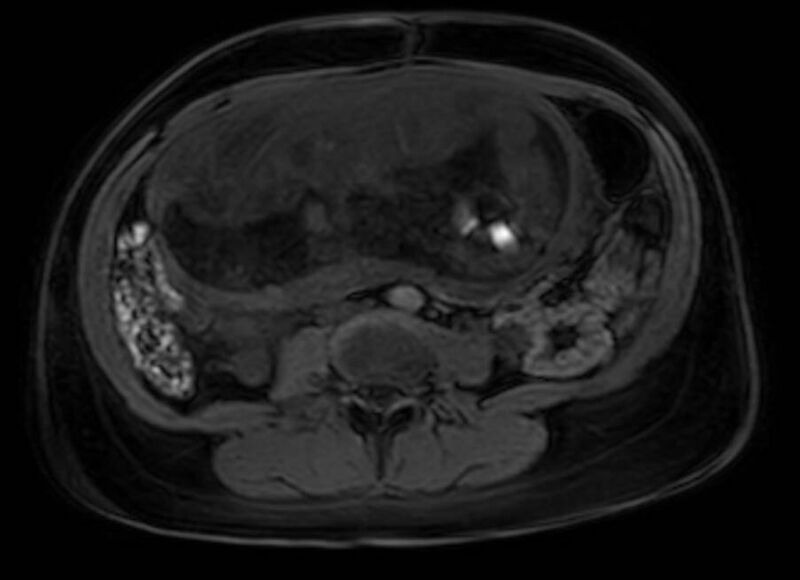 File:Appendicitis in gravida (MRI) (Radiopaedia 89433-106395 Axial DIXON 77).jpg