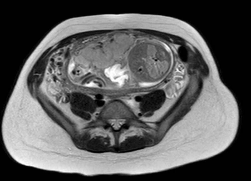 File:Appendicitis in gravida (MRI) (Radiopaedia 89433-106395 Axial T2 46).jpg