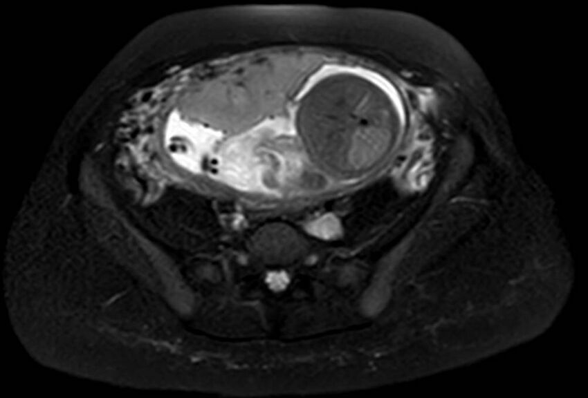 Appendicitis in gravida (MRI) (Radiopaedia 89433-106395 Axial T2 SPAIR 53).jpg
