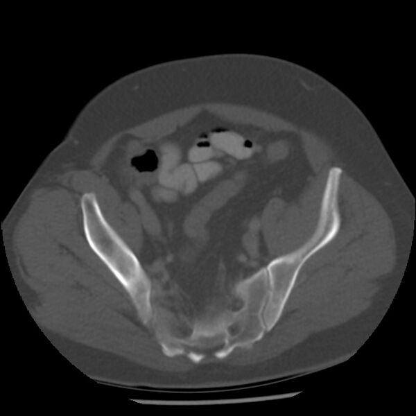 File:Appendicitis with perforation (Radiopaedia 35790-37342 Axial bone window 43).jpg