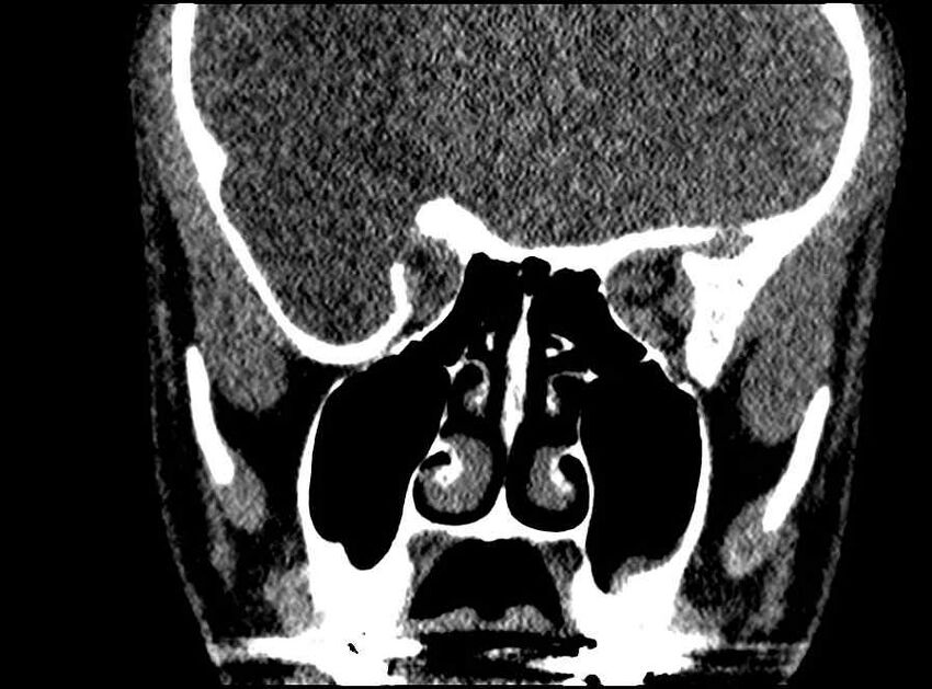 Arachnoid cyst- extremely large (Radiopaedia 68741-78450 Coronal bone window 39).jpg
