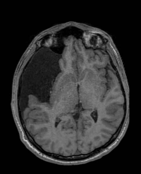 File:Arachnoid cyst- extremely large (Radiopaedia 68741-78451 Axial T1 38).jpg