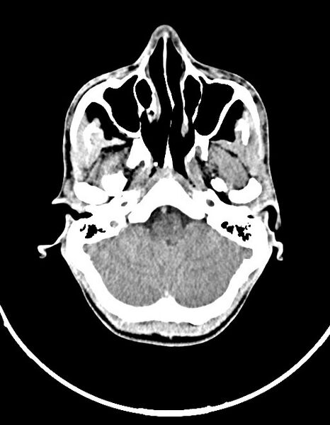 File:Arrow injury to the brain (Radiopaedia 72101-82607 Axial non-contrast 54).jpg