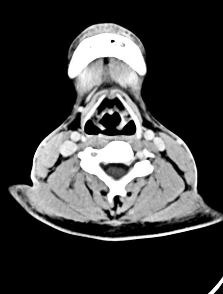 File:Arrow injury to the face (Radiopaedia 73267-84011 Axial C+ delayed 9).jpg
