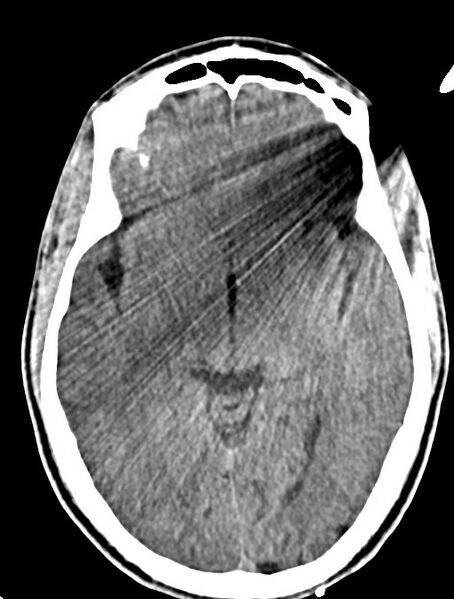 File:Arrow injury to the head (Radiopaedia 75266-86388 Axial non-contrast 22).jpg
