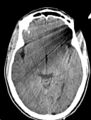 Arrow injury to the head (Radiopaedia 75266-86388 Axial non-contrast 22).jpg