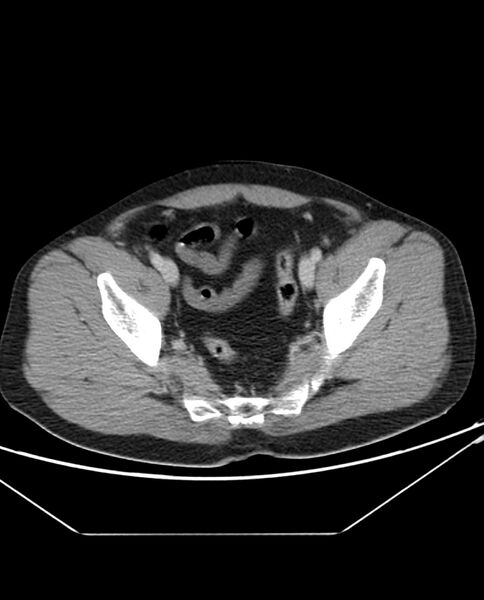 File:Arterial occlusive mesenteric ischemia (Radiopaedia 84641-100054 A 103).jpg
