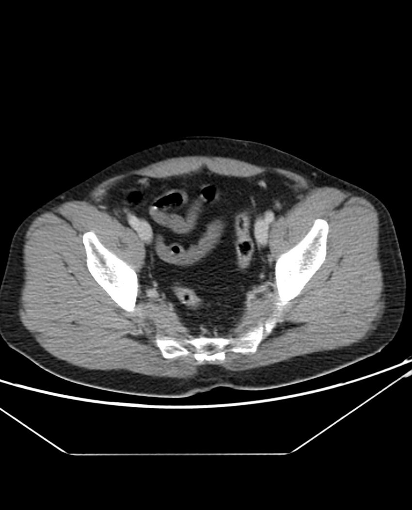 Arterial occlusive mesenteric ischemia (Radiopaedia 84641-100054 A 103).jpg
