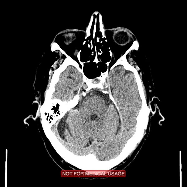 File:Artery of Percheron infarction (Radiopaedia 28679-28967 Axial non-contrast 35).jpg