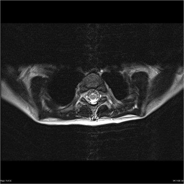 File:Arthrogryposis and muscle atrophy (Radiopaedia 24081-24314 B 4).jpg