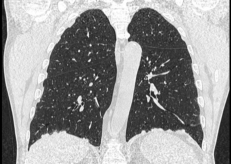 File:Asbestos pleural placques (Radiopaedia 57905-64872 Coronal lung window 194).jpg