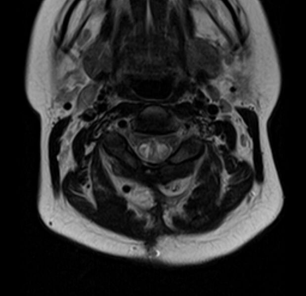 File:Astrocytoma - spinal cord (Radiopaedia 69769-79758 Axial T2 8).jpg