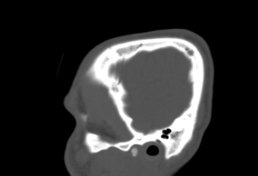 Asymptomatic occipital spur (Radiopaedia 87753-104201 Sagittal bone window 20).jpg