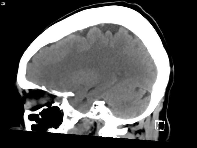 File:Atypical meningioma - intraosseous (Radiopaedia 64915-73867 C 23).jpg