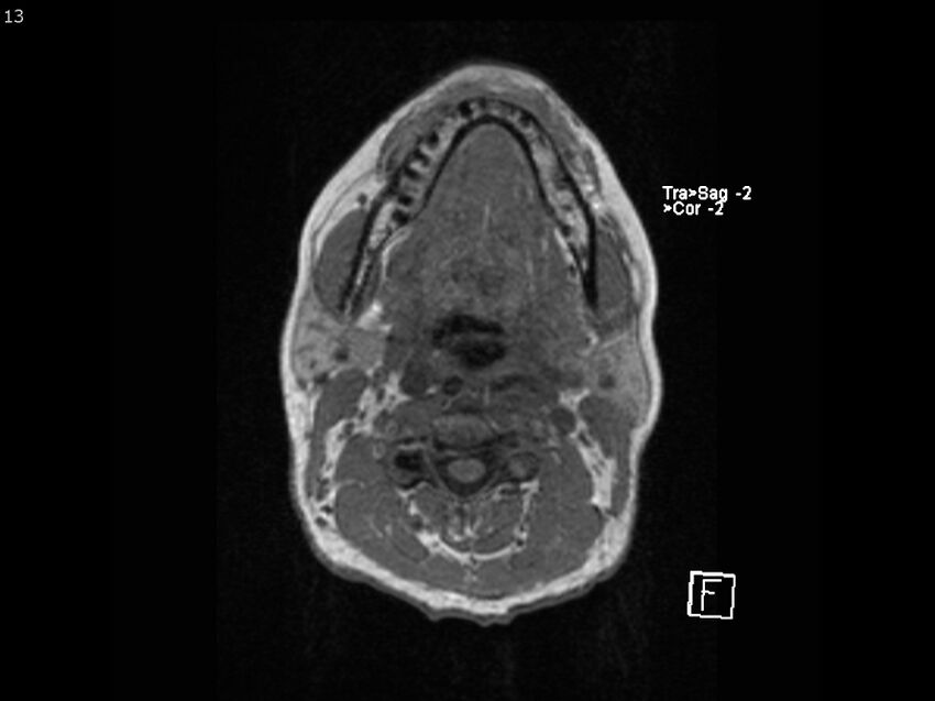 Atypical meningioma - intraosseous (Radiopaedia 64915-74572 Axial T1 13).jpg