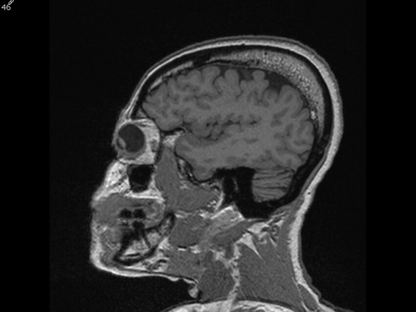 Atypical meningioma - intraosseous (Radiopaedia 64915-74572 Sagittal T1 46).jpg