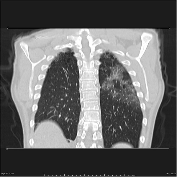 File:Atypical pneumonia - Q fever (Radiopaedia 21993-21989 C 36).jpg